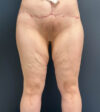 Mommy Makeover case #19153
