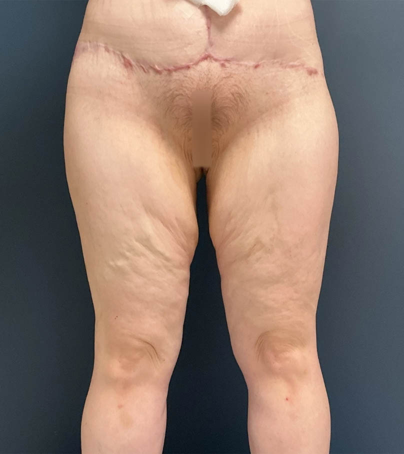 Mommy Makeover case #19153
