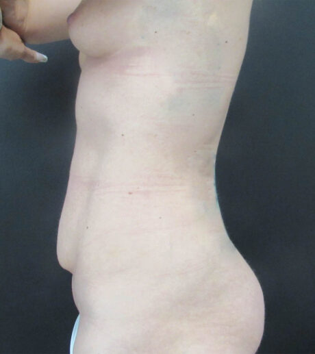 Breast Augmentation case #19118