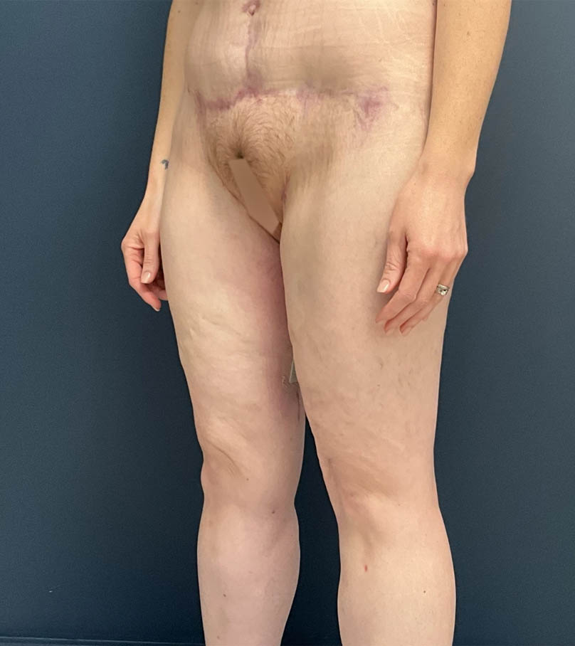 Mommy Makeover case #19153
