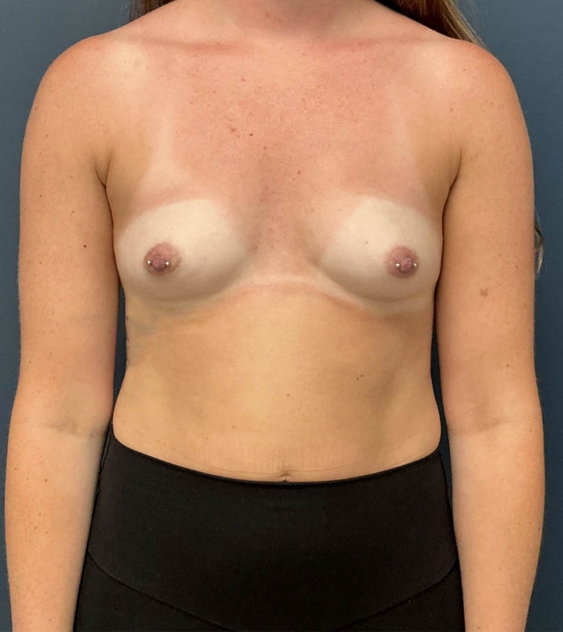 Breast Augmentation case #19125