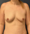 Breast Augmentation case #18795