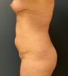 Tummy Tuck case #18664