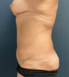 Tummy Tuck case #18664