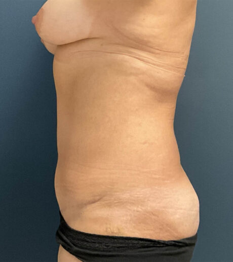 Tummy Tuck case #18664