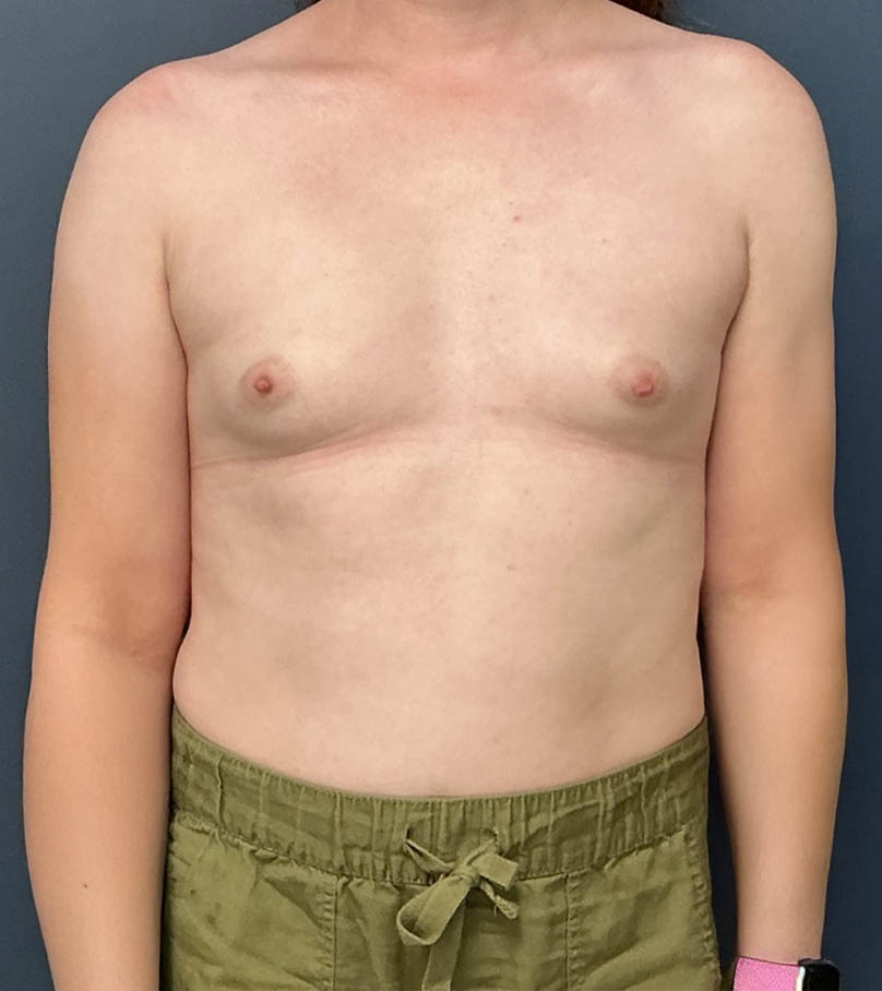 Breast Augmentation case #19132