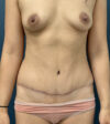 Tummy Tuck case #18671