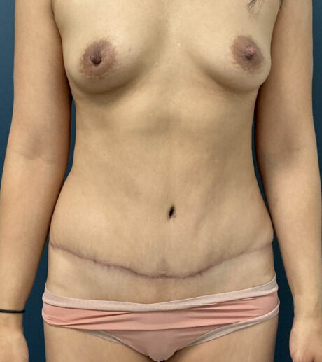 Tummy Tuck case #18671