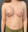 Breast Augmentation case #19132