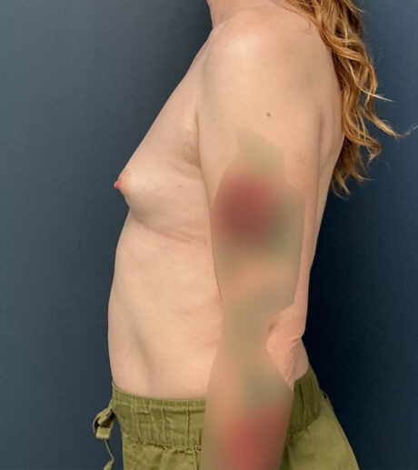 Breast Augmentation case #19132