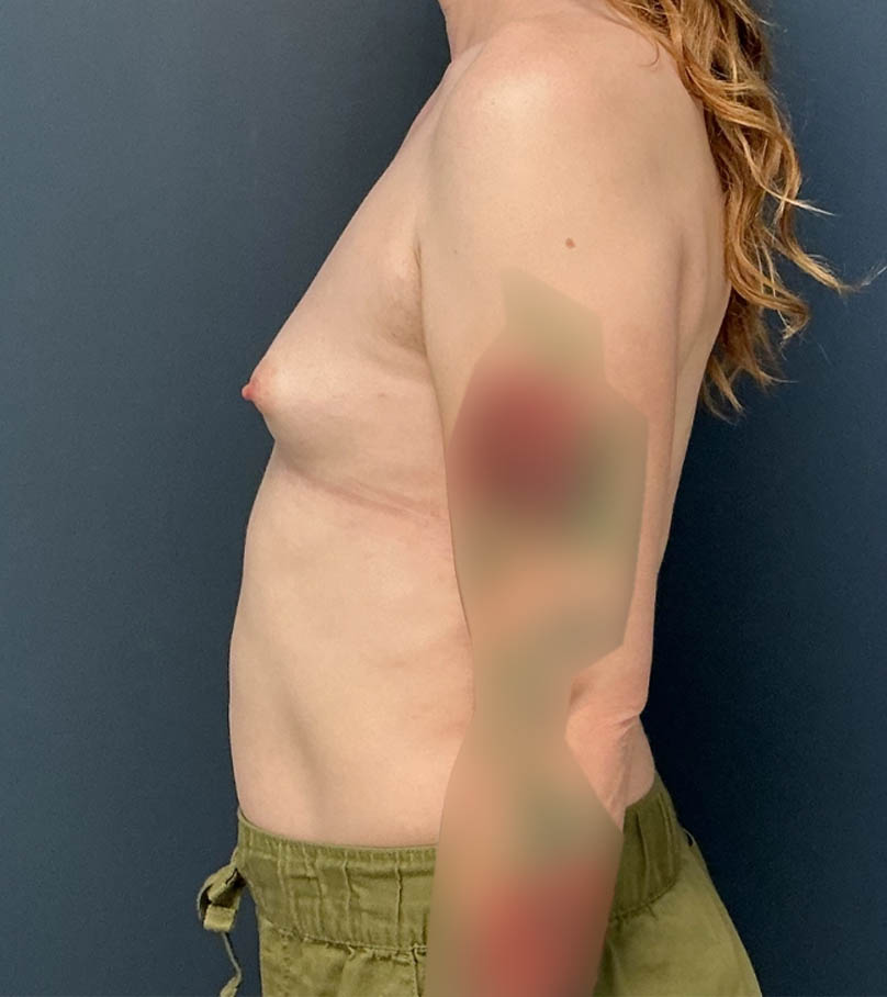 Breast Augmentation case #19132