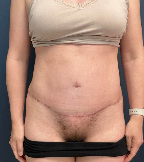 Tummy Tuck case #18678