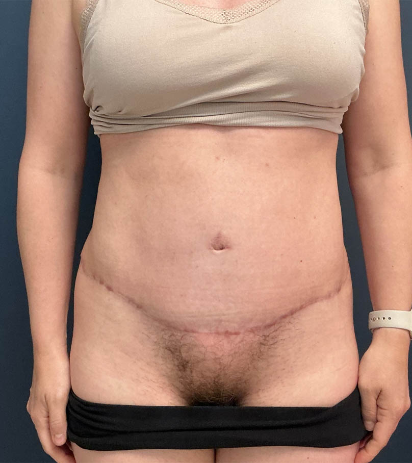 Tummy Tuck case #18678