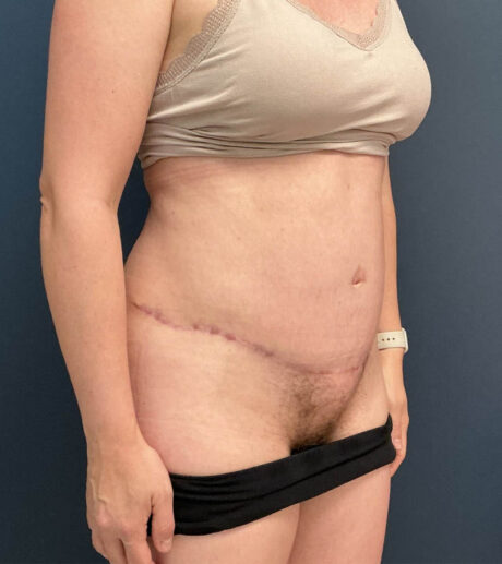Tummy Tuck case #18678