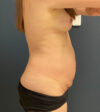Tummy Tuck case #18678