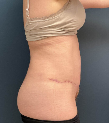Tummy Tuck case #18678