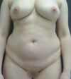 Breast Lift case #19146