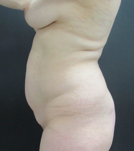 Breast Lift case #19146