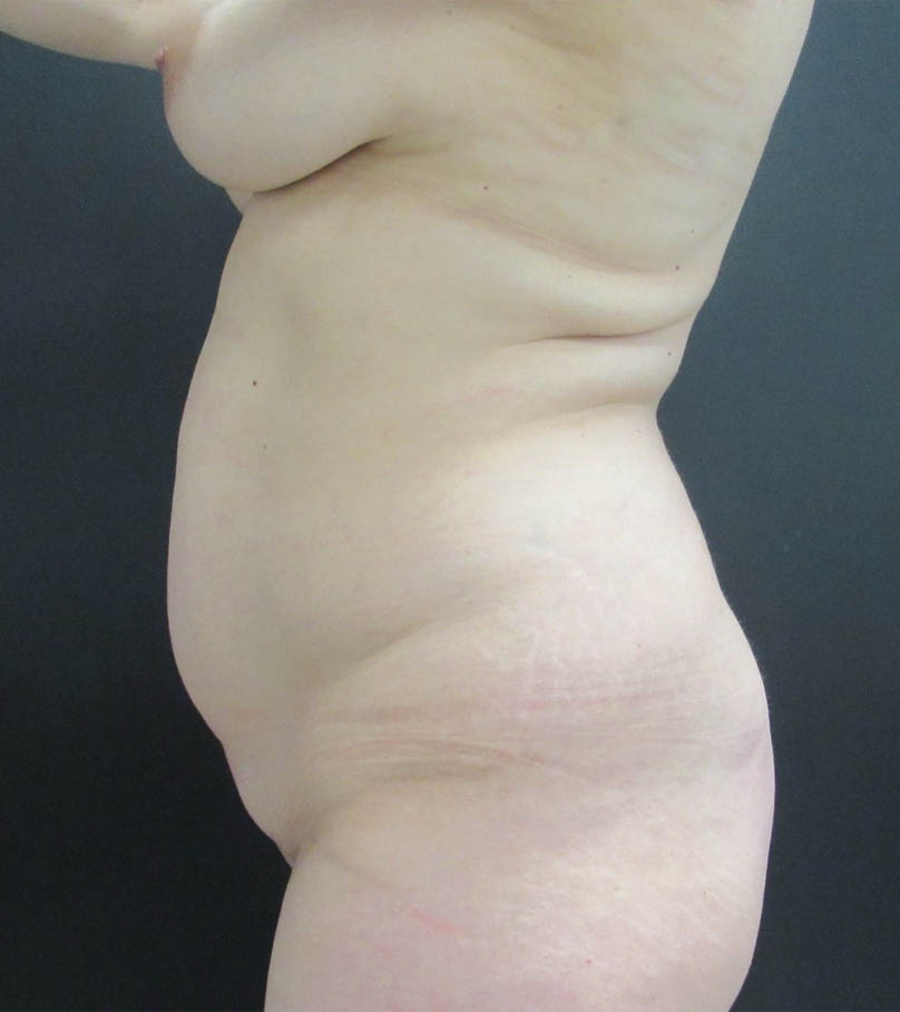 Breast Lift case #19146