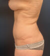 Breast Lift case #19146