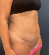 Tummy Tuck case #18685