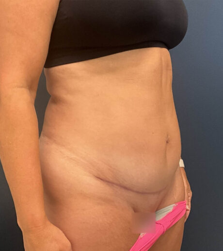 Tummy Tuck case #18685