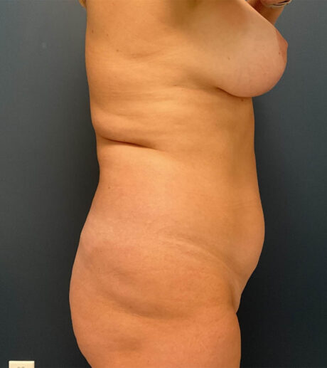 Tummy Tuck case #18685