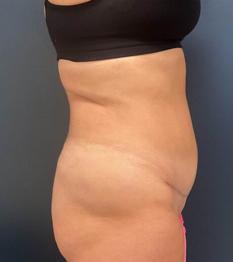 Tummy Tuck case #18685