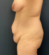 Mommy Makeover case #19153