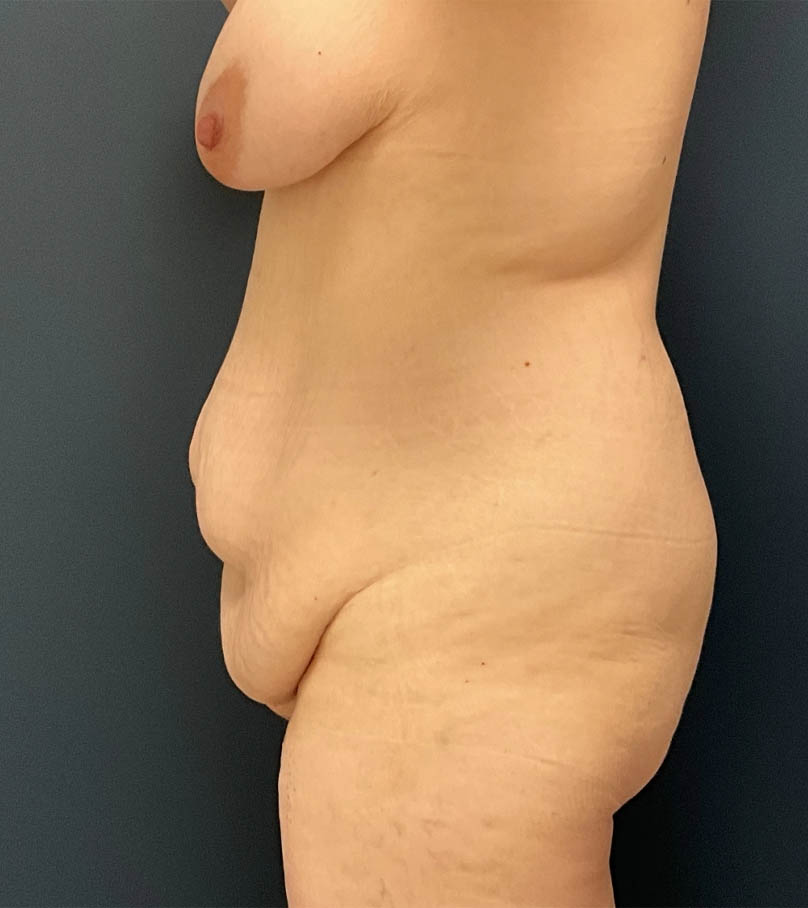 Mommy Makeover case #19153