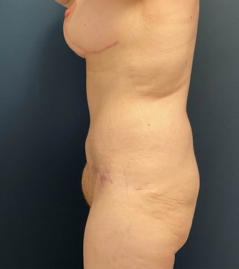 Mommy Makeover case #19153