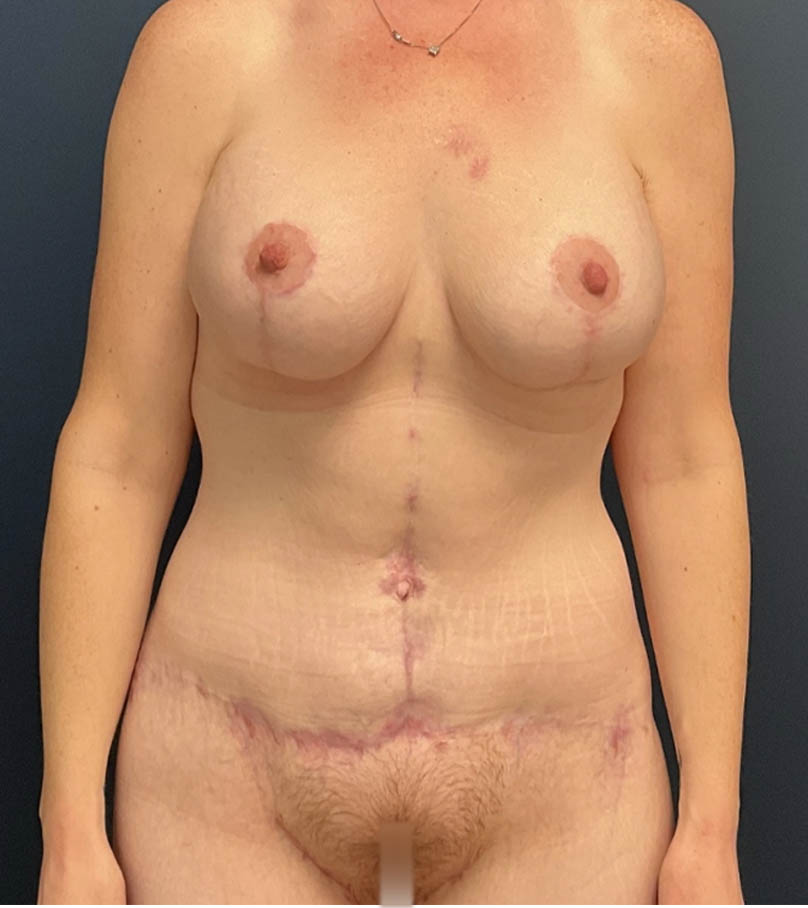 Mommy Makeover case #19153