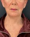 Facelift case #18828