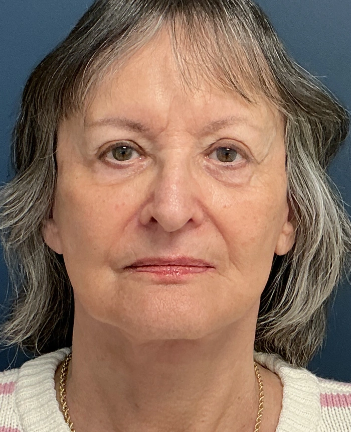 Facelift case #18830