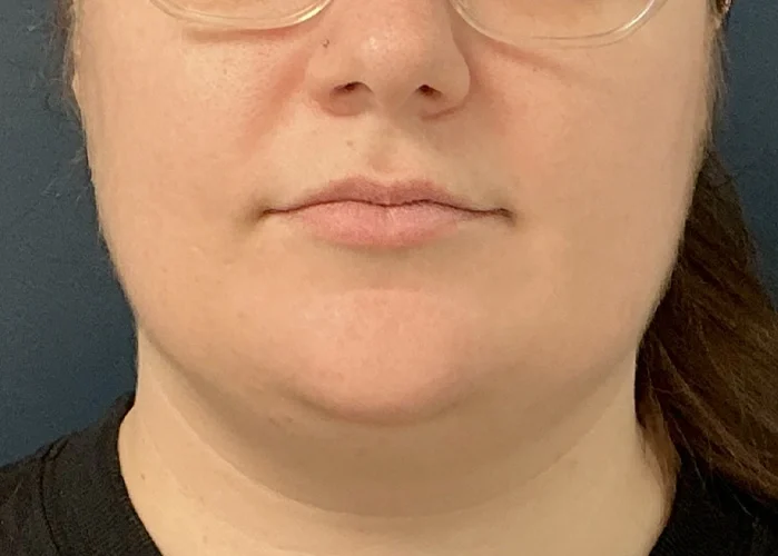 Chin Liposuction case #18832