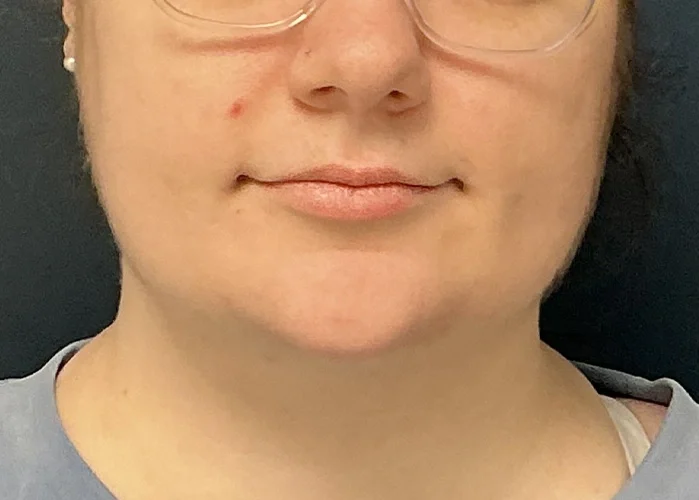 Chin Liposuction case #18832