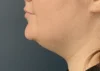 Chin Liposuction case #18832
