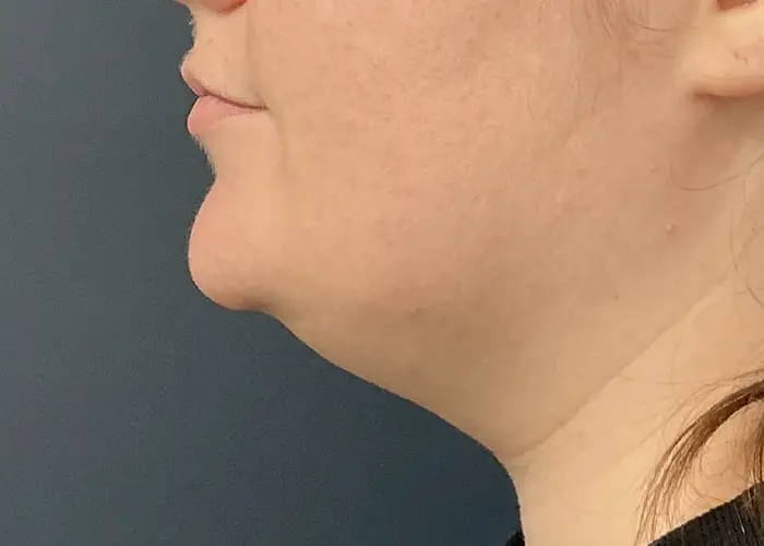 Chin Liposuction case #18832