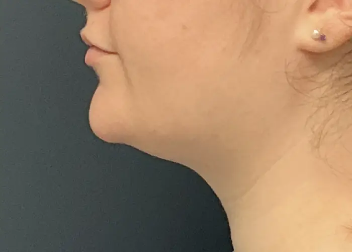 Chin Liposuction case #18832