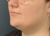 Chin Liposuction case #18832