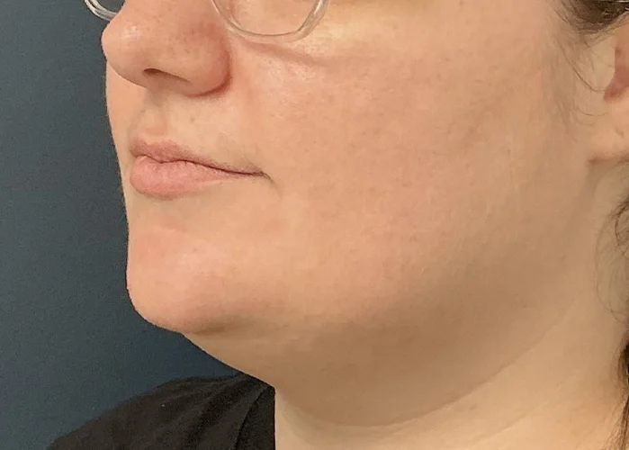 Chin Liposuction case #18832