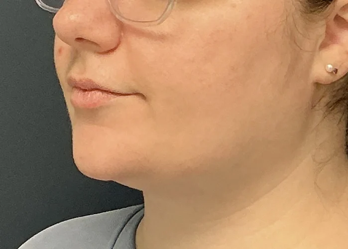 Chin Liposuction case #18832