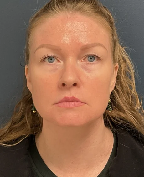 Neck Lift case #18833