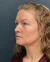 Neck Lift case #18833