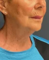 Facelift case #18828