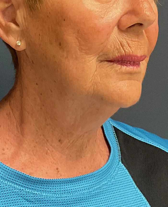 Facelift case #18828