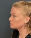 Neck Lift case #18833