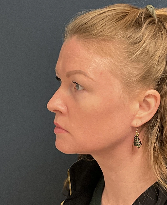 Neck Lift case #18833
