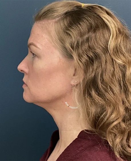 Neck Lift case #18833
