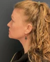 Neck Lift case #18833